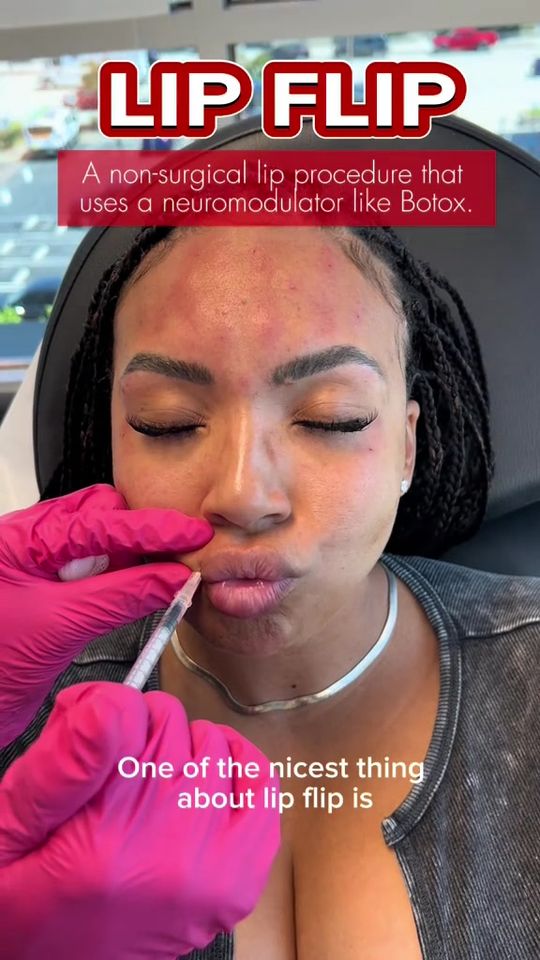 Video by Dr. Kay Durairaj: Sexy lips with a small enchantment 🤩🤩 would you try a lip flip?