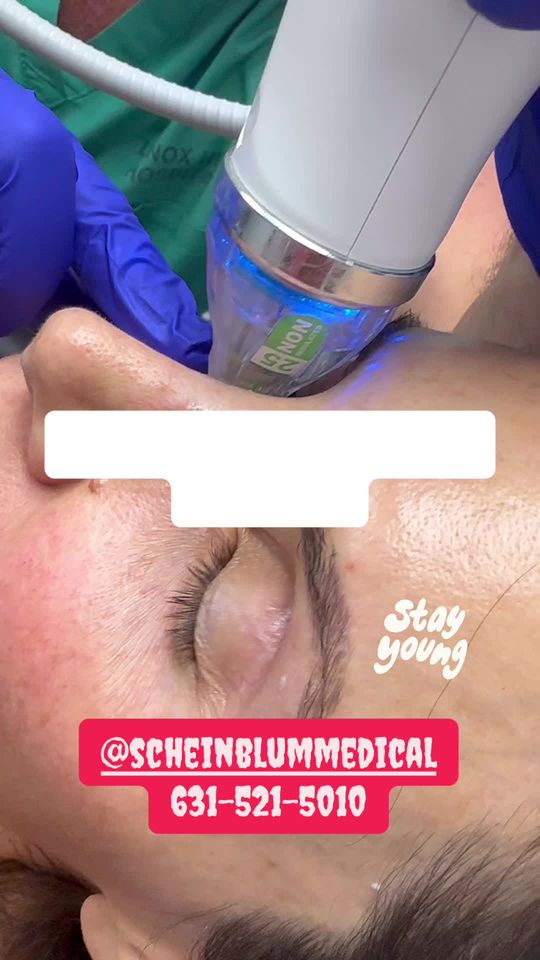 Video by Dr. Keith Scheinblum: Secret Rf to rejuvenate and tighten your skin on your face and body. Remodel your skin from the i…