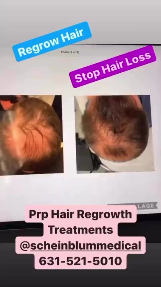 Video by Dr. Keith Scheinblum: Patient completed 3 treatments of platelet rich plasma injections spaced one month apart. These b…
