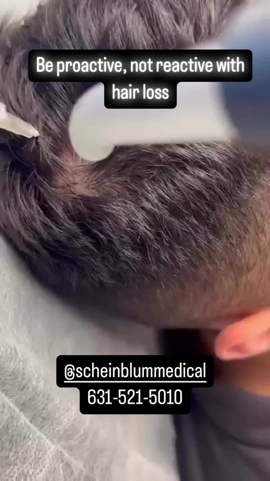 Video by Dr. Keith Scheinblum: Platelet Rich Plasma Hair Injections help increase the density and thickness of your hair. Patien…
