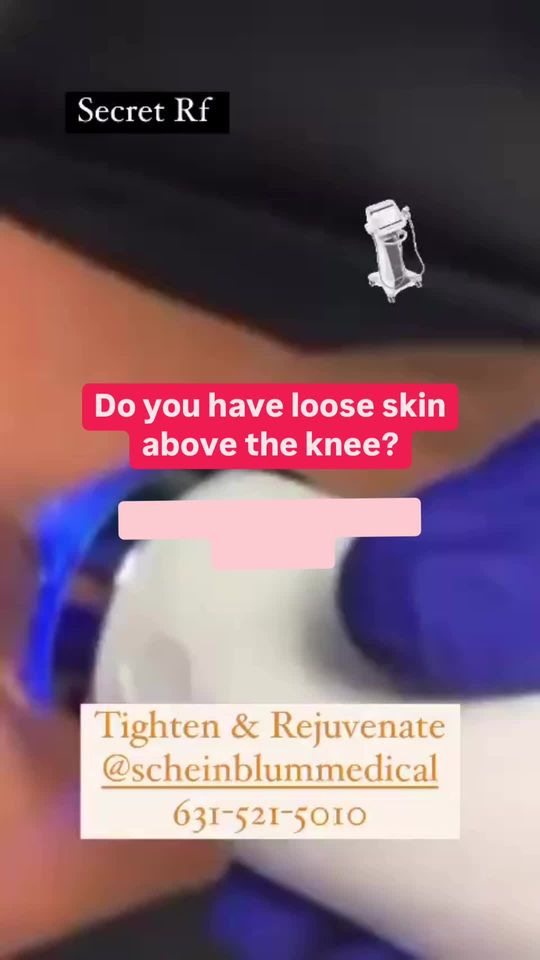 Video by Dr. Keith Scheinblum: Secret Rf for skin rejuvenation and tightening anywhere on the body. Patients can treat hands , e…