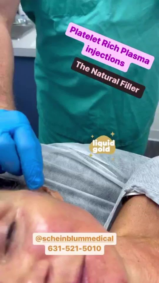 Video by Dr. Keith Scheinblum: Watch up close as Dr Scheinblum injects Platelet Rich Plasma to fill under eye hollows, nasal lab…