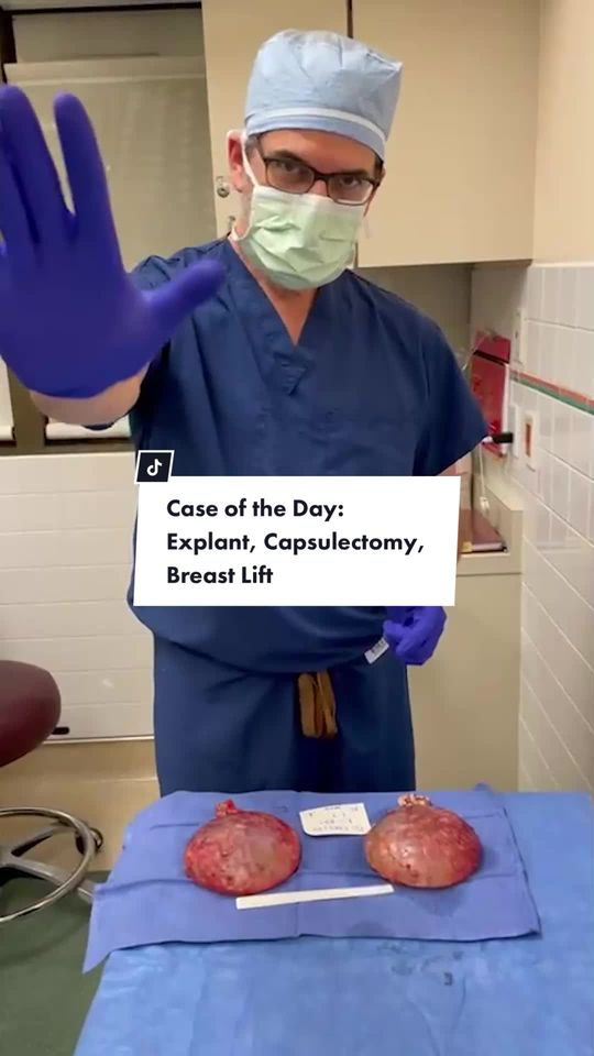 Video by Dr. Kevin Brenner: My patient had breast implant illness type symptoms... I did a removal of saline implants with to…