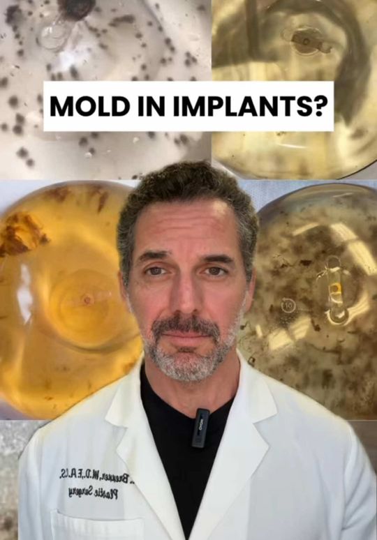 Video by Dr. Kevin Brenner: 😳 Yes, mold can grow in a saline implant. If the implant is damaged or contaminated during surge…