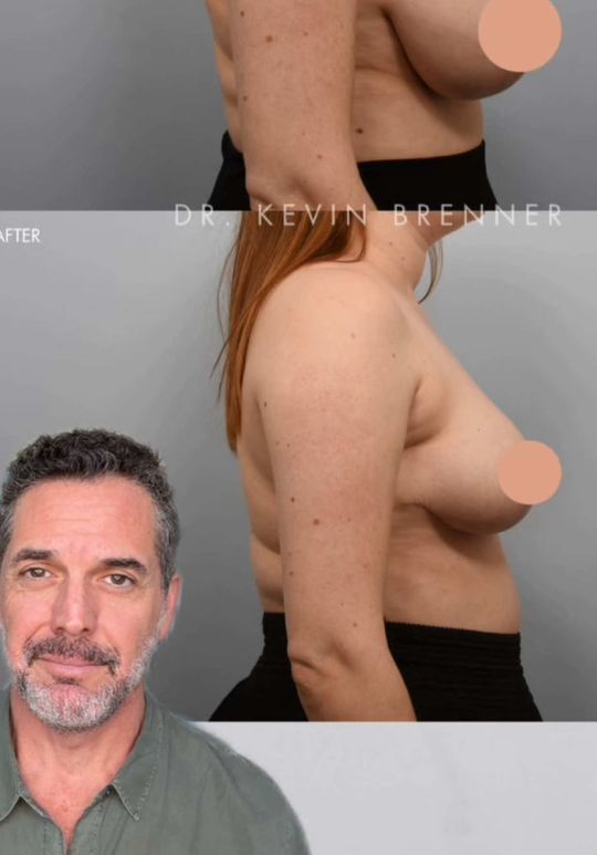 Video by Dr. Kevin Brenner: This wonderful patient shown 3 months after bilateral breast reduction surgery. Pre-operatively,…