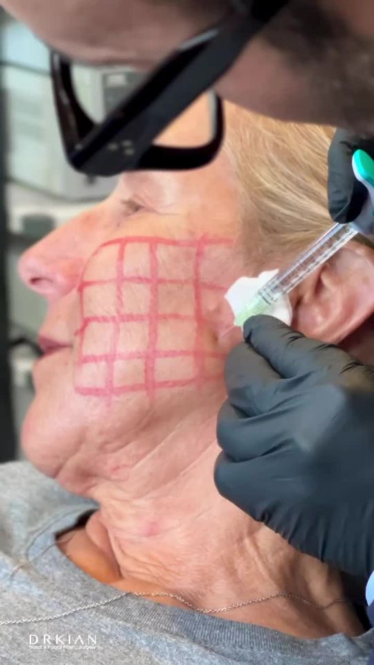 Video by Dr. Kian Karimi: I’m excited to share we are one of the very first cosmetic centers to offer @SKINVIVE, the all-ne…