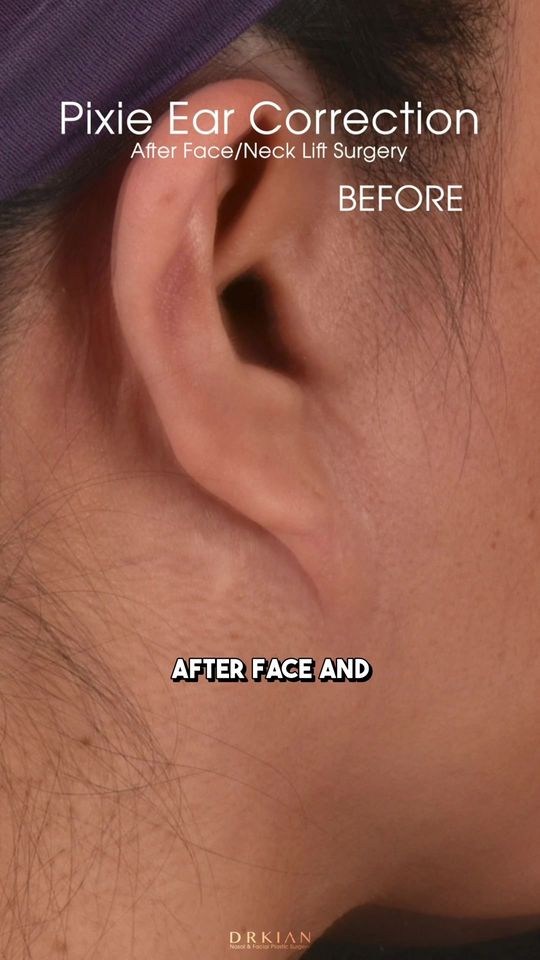 Video by Dr. Kian Karimi: Today’s 𝗣𝗮𝘁𝗶𝗲𝗻𝘁 𝗖𝗮𝘀𝗲 𝗛𝗶𝗴𝗵𝗹𝗶𝗴𝗵𝘁 has to do with 'Pixie Ears.’ I recently met th…