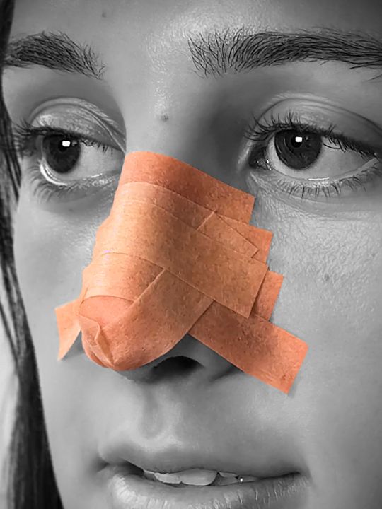 Video by Dr. Kian Karimi: Nose taping is an essential aftercare step in the recovery process following a rhinoplasty. The p…