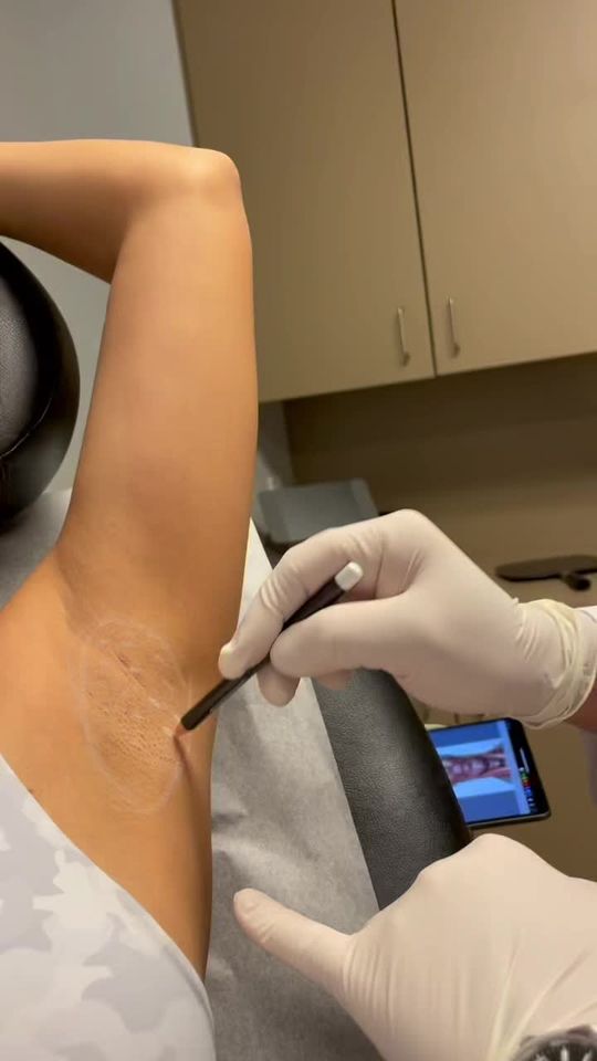Video by Dr. Konstantin Bukov: Underarm Botox is using for a medical purpose! It helps with