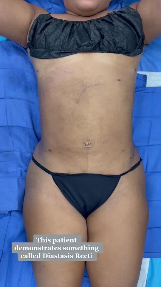 Video by Dr. Kristopher Hamwi: Diastasis Recti is a very common condition where the abdominal muscles separate, often due to pre…