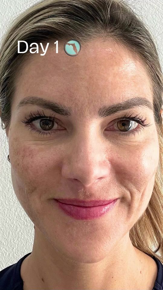 Video by Dr. Kristopher Hamwi: Welcome our newest medspa service at Florida Plastic Surgery and Medspa! 👋 Introducing the new Z…