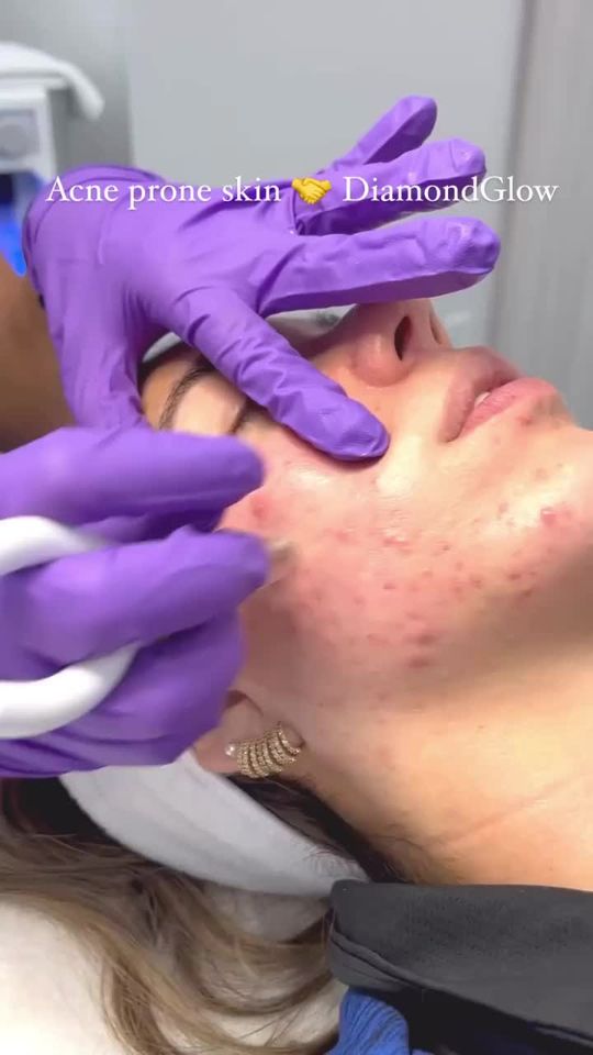 Video by Dr. Kristopher Hamwi: Acne prone skin 🤝 DiamondGlow