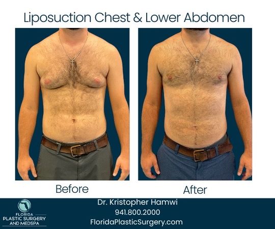 Video by Dr. Kristopher Hamwi: **MALE AWAKE LIPOSUCTION: BEFORE & AFTER 📸** Check out the incredible transformation of our 29-y…