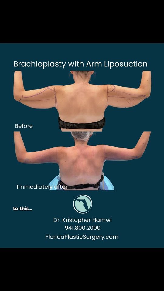 Video by Dr. Kristopher Hamwi: A behind-the-scenes look at Dr. Hamwi’s awake arm lift technique 💪 The patient stays completely…