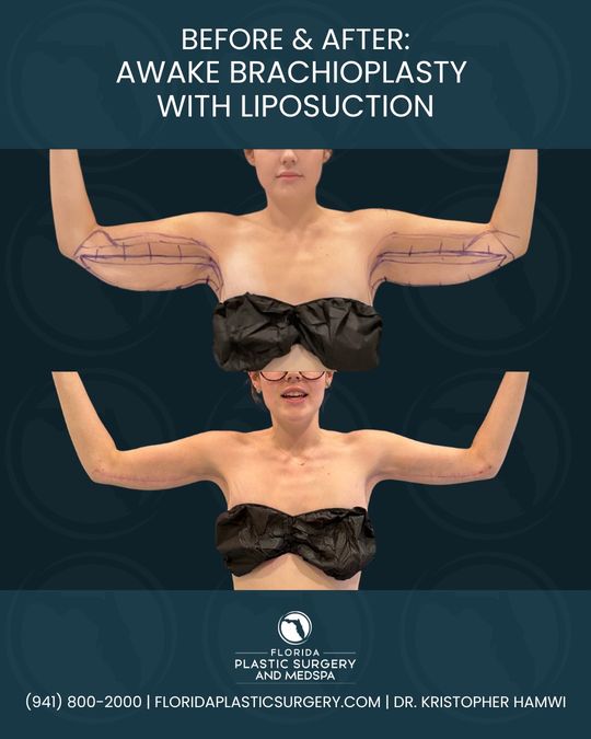 Video by Dr. Kristopher Hamwi: 💪 Awake Brachioplasty (Arm Lift) with Liposuction 👨‍⚕️ Performed by Dr. Kristopher Hamwi If you…