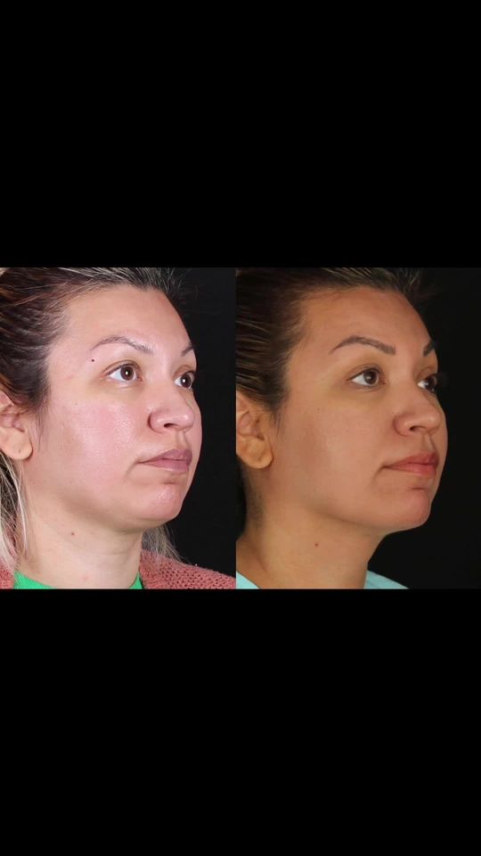 Video by Dr. Kyle Kimura: We love seeing these subtle but great results after chin laser liposuction with the @sciton_inc j…