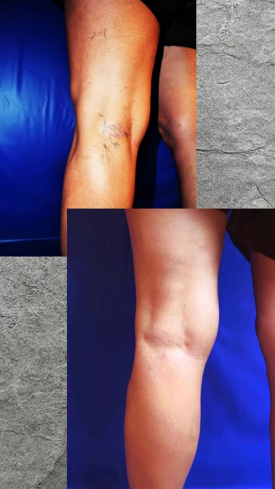 Video by Dr. L. Mark Khitin: Let's Talk About Veins. NY Vein Treatment Center Addresses: Manhattan: 30 Park Avenue, New York,…