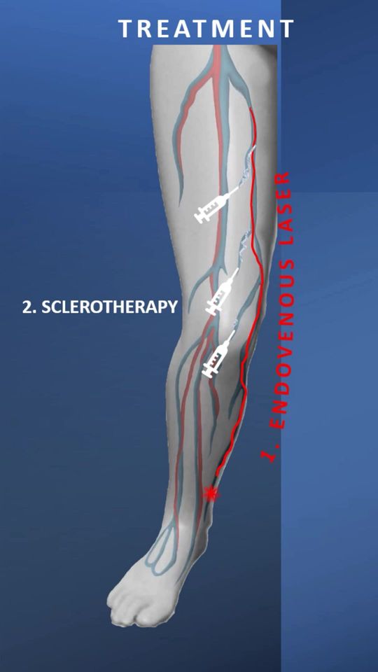 Video by Dr. L. Mark Khitin: Varicose Veins 101