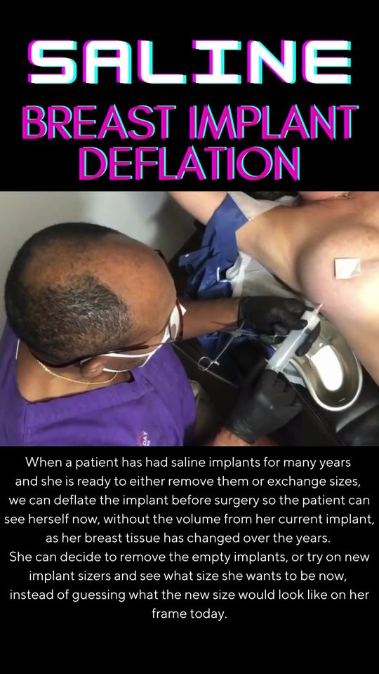 Video by Dr. Larry C. Leverett: When a patient has had saline implants for many years and she is ready to either remove them or e…