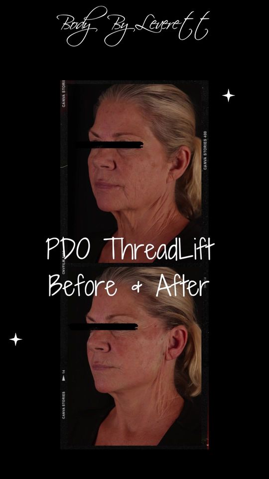 Video by Dr. Larry C. Leverett: PDO THREADLIFT RESULTS - Before and After of PDO Threadlift Treatment. PDO Threads are a minimall…