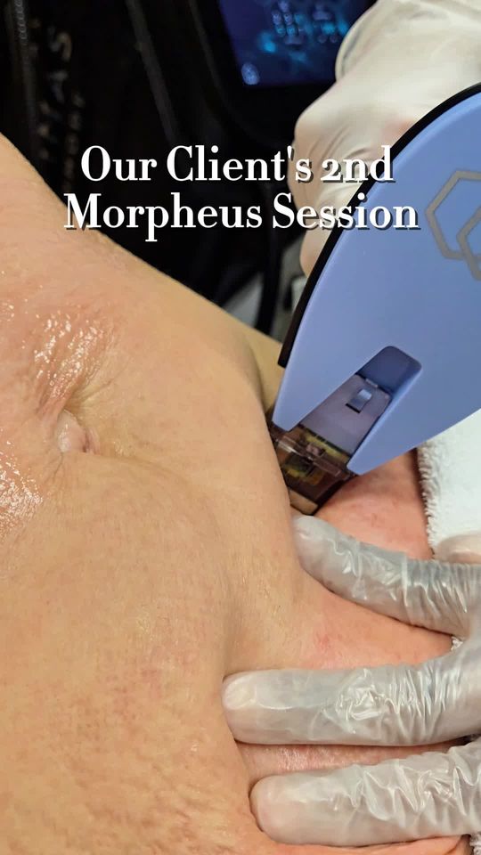 Video by Dr. Larry C. Leverett: ✨ Session 2 is in the books! ✨ Morpheus8 works below the surface to: 💜 Tighten loose skin 💜 Tar…