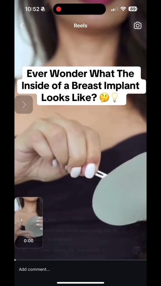 Video by Dr. Larry Fan: Ever wonder what's inside a breast implant? Modern implants are marvels of medical engineering -…