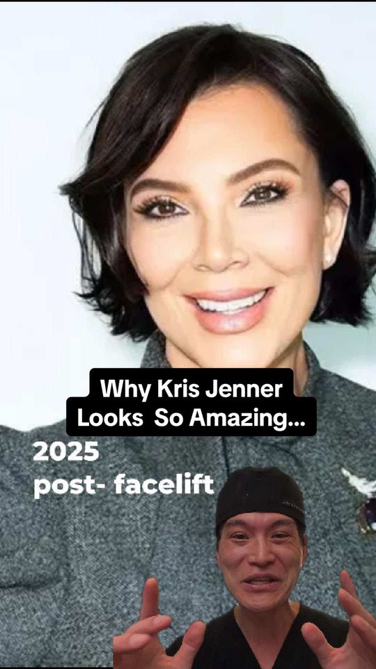 Video by Dr. Larry Fan: The verdict is in: Kris Jenner's new look is a masterclass in modern facelifts. That natural, not…