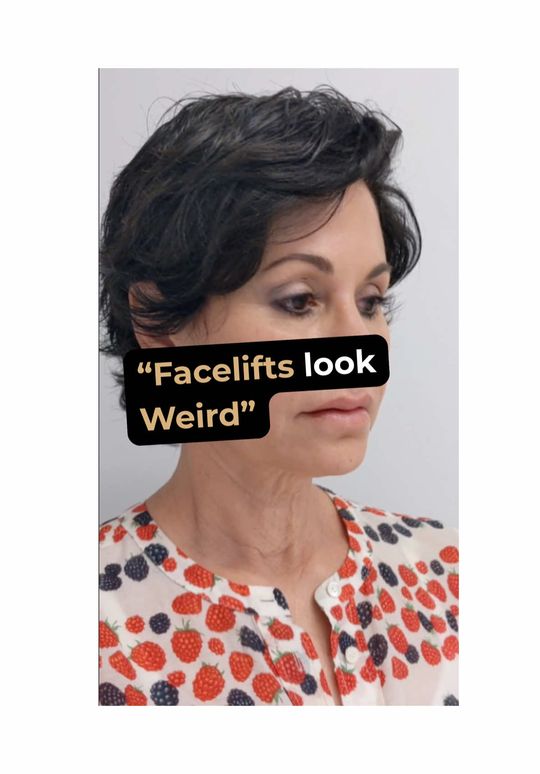 Video by Dr. Larry Fan: “Facelifts look weird…” 🤡 FALSE ❌ When done right, a facelift doesn’t change who you are — it re…