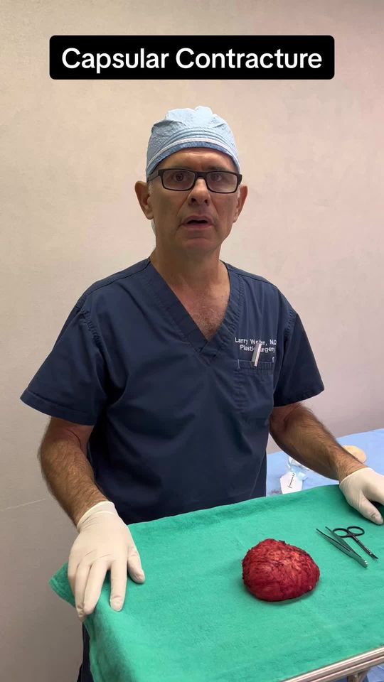 Video by Dr. Laurence Weider: Up close look at a thick breast implsnt capsule in a patient who had a capsular contracture.