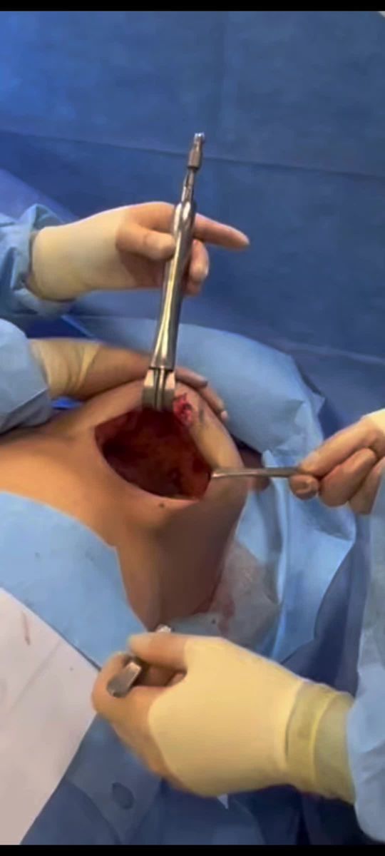 Video by Dr. Laurence Weider: Breast Explant anatomy: subglandular implant removal.