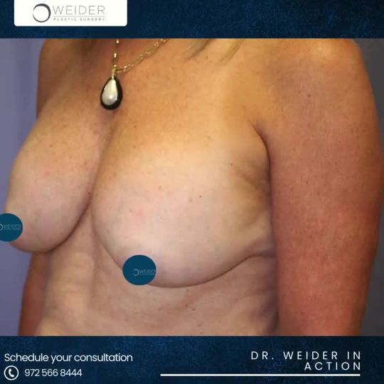 Video by Dr. Laurence Weider: Removal and replacement of implants with lift.