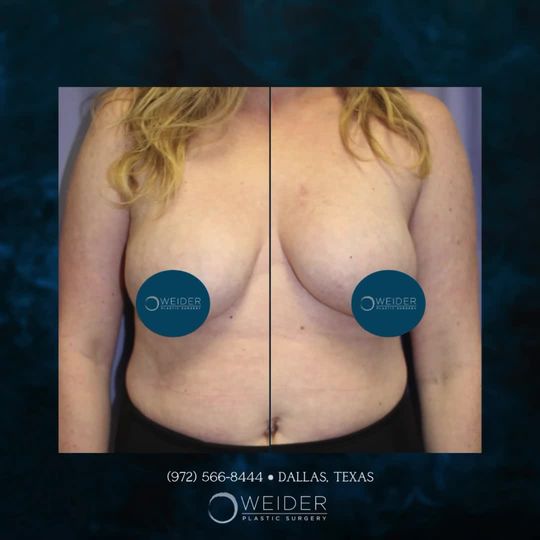 Video by Dr. Laurence Weider: Explant and Lift.