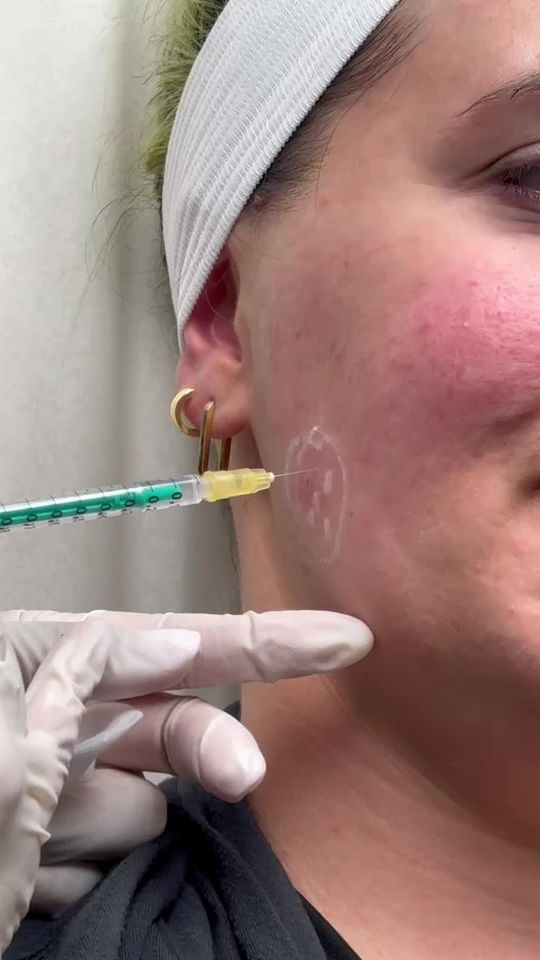 Video by Dr. Lisa Benest: The masseter muscle is a facial muscle that connects your lower jaw to your cheek. It is one of s…