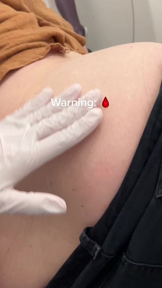 Video by Dr. Lisa Gardner: Heres a wuick video of how we insert hormones into our patients!