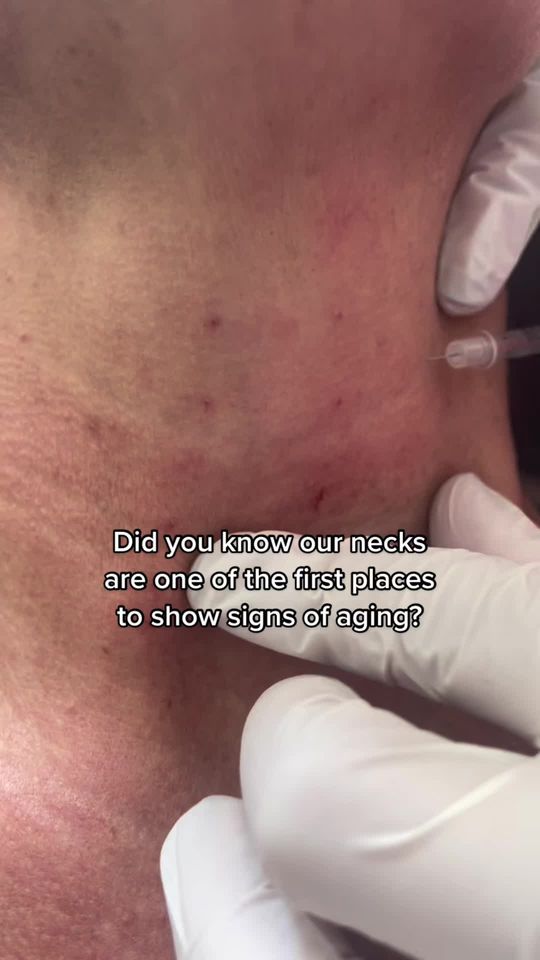 Video by Dr. Lisa Gardner: Dysport injections can do amazing things for wrinkles along the neck!