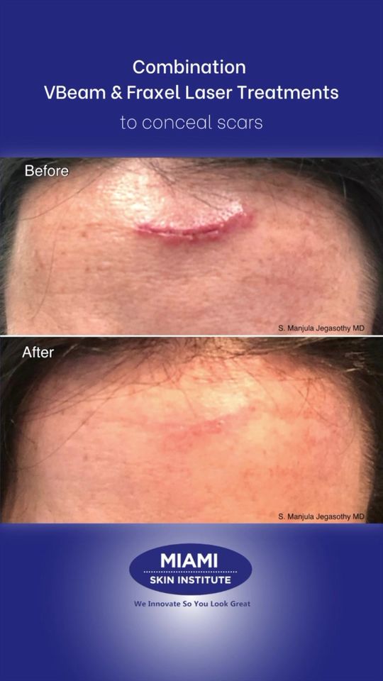 Video by Dr. Manjula Jegasothy: Looking to reduce the appearance of your ⁉️ Whether it’s # # we can help you greatly diminish the…