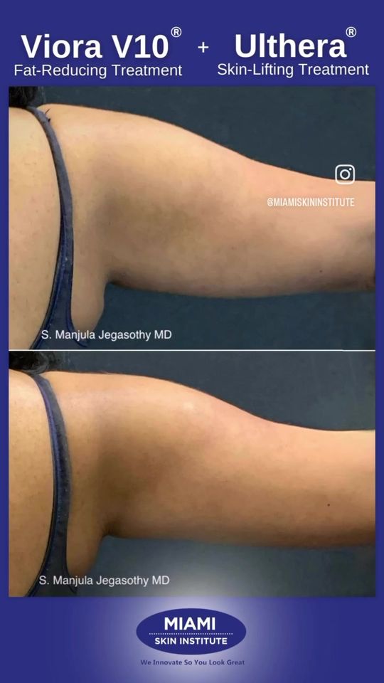 Video by Dr. Manjula Jegasothy: As we age, begins appearing on our upper 🙋🏻💪🏽, commonly known as 🦇🙅🏻👎🏼 Fortunately, 👩🏽…