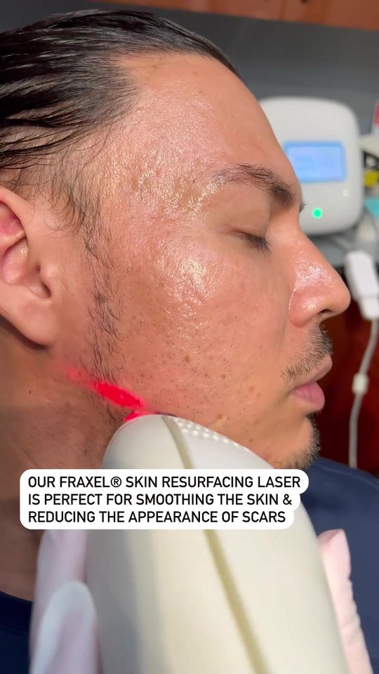 Video by Dr. Manjula Jegasothy: + topical (no needles 😁) far better than Fraxel® alone! Here☝🏼, we show much better results on…