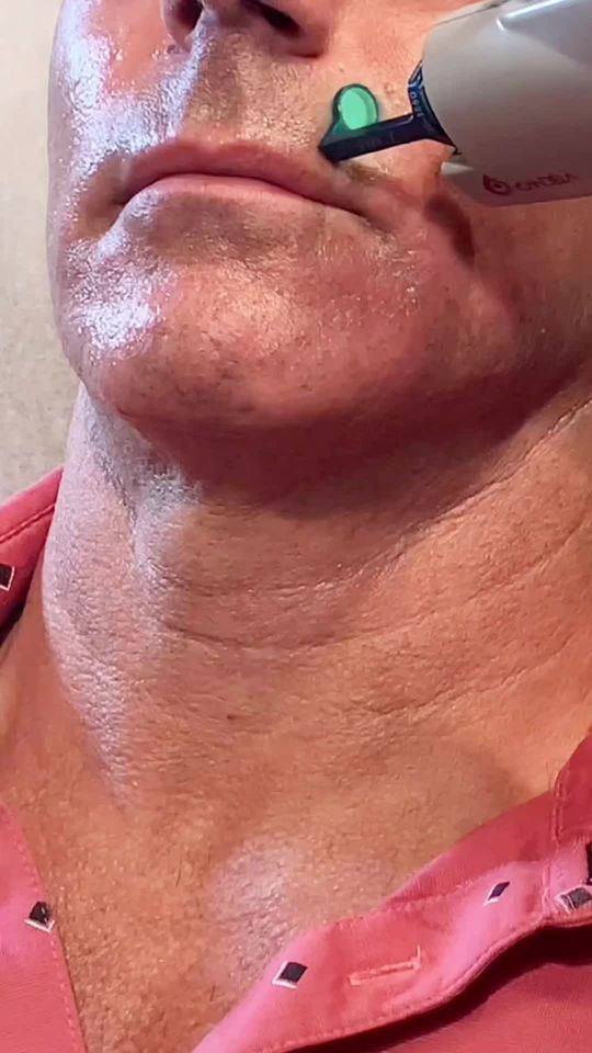 Video by Dr. Manjula Jegasothy: Enhance your complexion with our ® treatment! 😍💥 👩🏽‍⚕️ has unparalleled precision & VBeam® pr…