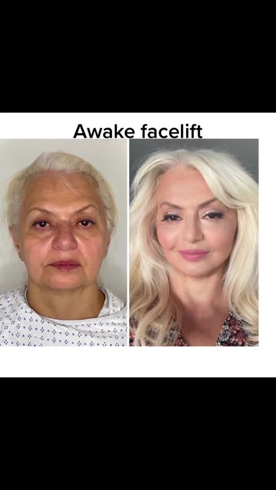 Video by Dr. Mansher Singh: Wonderful transformation after and The surgery was performed with patient being awake yet comfort…