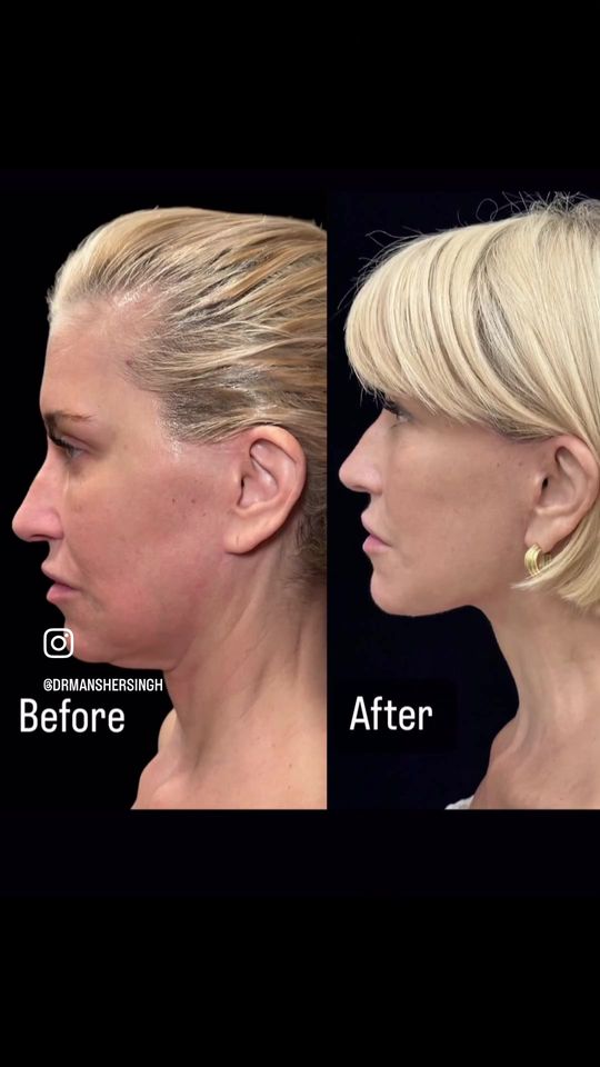 Video by Dr. Mansher Singh: 💭 Ever wondered what recovery from a looks like? Here’s a sneak peek! 👀 Swipe through this amaz…