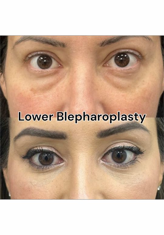 Video by Dr. Mansher Singh: Did you know lower blepharoplasty can be combined with facial fat transfer for the most natural r…
