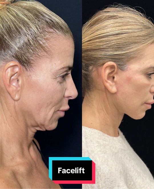 Video by Dr. Mansher Singh: 6 months post-op, and she’s glowing! ✨ At 58, this patient wanted a natural, refreshed look witho…