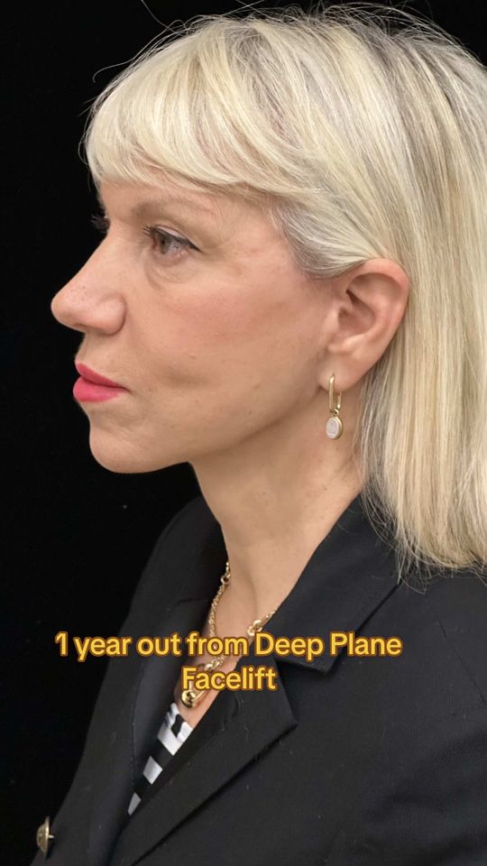 Video by Dr. Mansher Singh: 🎯 Longevity is everything. The most important part of any facial rejuvenation isn’t just the imm…