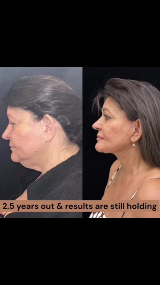 Video by Dr. Mansher Singh: 🎥✨ Long-term results are EVERYTHING! This wonderful patient had a Deep Plane Facelift 2½ years a…