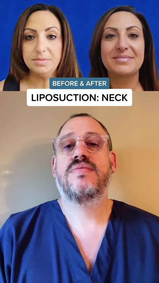Video by Dr. Marc Elkowitz: That smile says it all! Great results and a great reaction