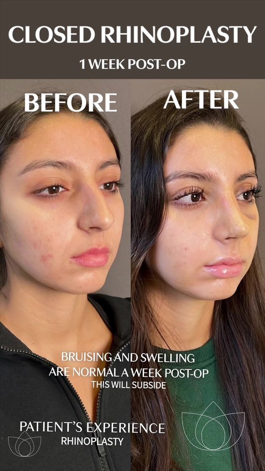 Video by Dr. Mark G. Albert: A week later and this patient is already so happy with her results. Her nose will look even bette…