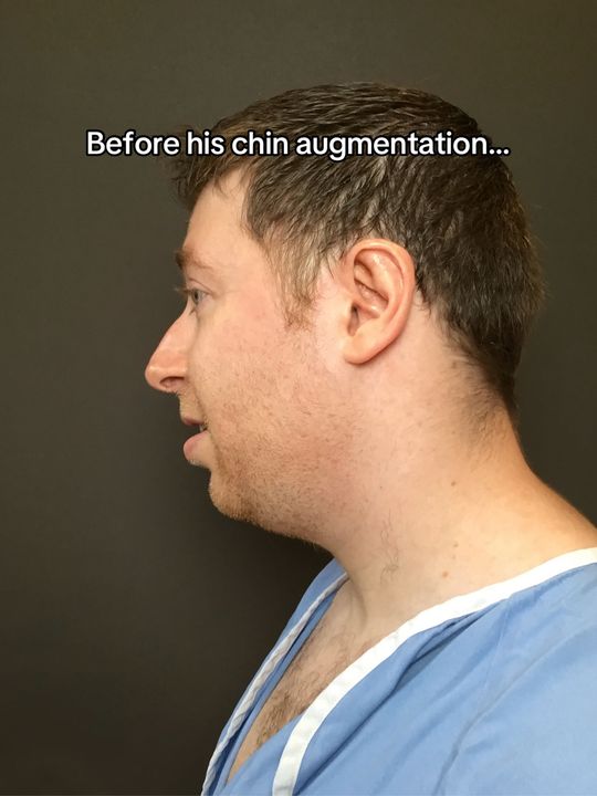 Video by Dr. Mark G. Albert: This Transformation Thursday we have this incredible chin augmentation— 4 months apart! 🤩 The ch…