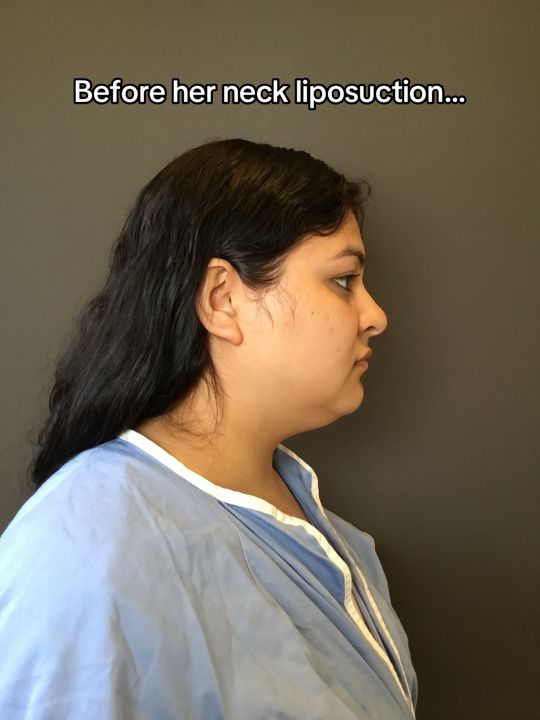 Video by Dr. Mark G. Albert: This Transformation Thursday we have a fabulous neck liposuction result 🤩 This patient is only a…