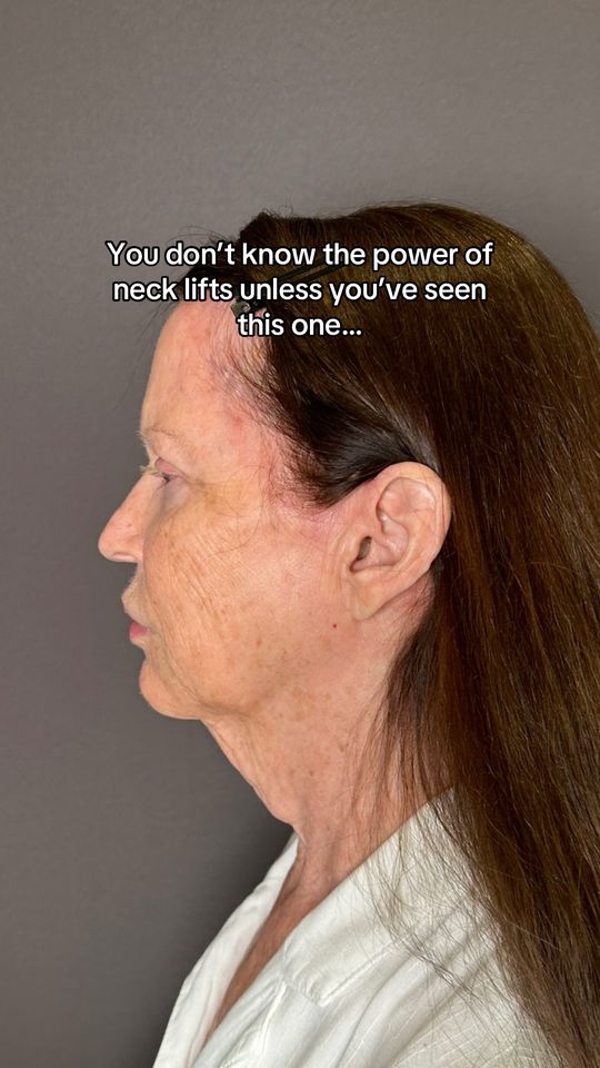 Video by Dr. Mark G. Albert: Just 7 days after her neck lift procedure, this patient’s gorgeous results are shining through al…